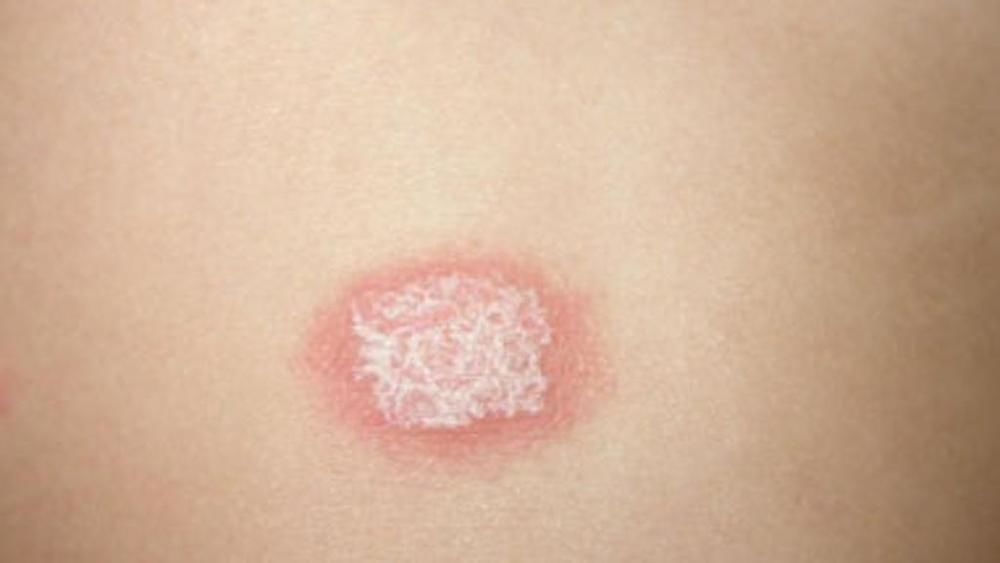 Psoriasi, tra Cagliari e Provincia affette 6 mila persone