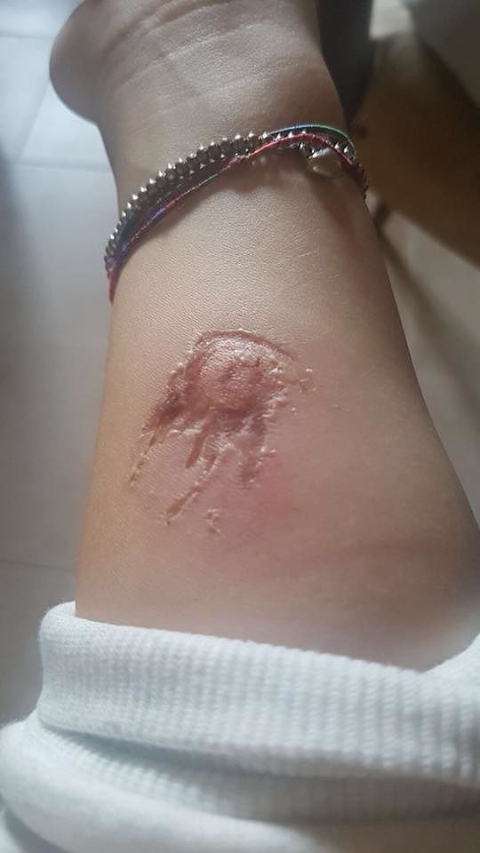 Cagliari, ragazza morsicata in discoteca: “Aggredita, ora ha un’infezione”