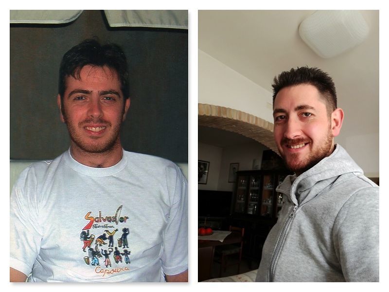 Bryan muore a 30 anni di melanoma, il fratello: “Lo screening può salvare la vita”