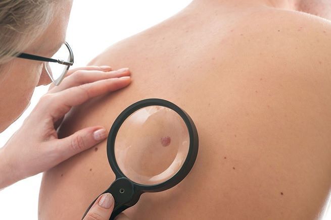 Visite gratis nel Cagliaritano per prevenire i tumori alla pelle: approfittatene oggi e domani