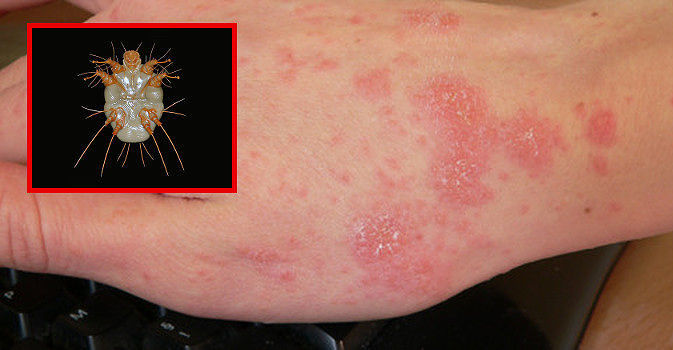 Scabbia, focolaio in una scuola del cagliaritano: studenti contagiati