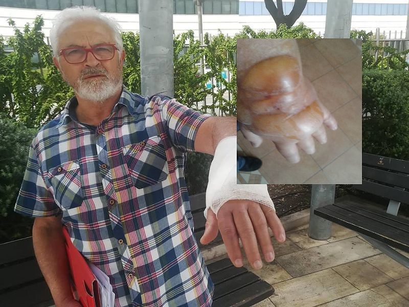 Saverio, odissea in ospedale a Cagliari: “Mano piena di bolle per colpa dell’ago infilato fuori vena”