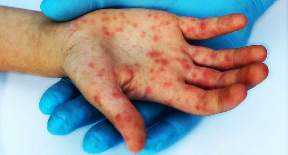 Galles, un caso di vaiolo bovino in un ragazzo