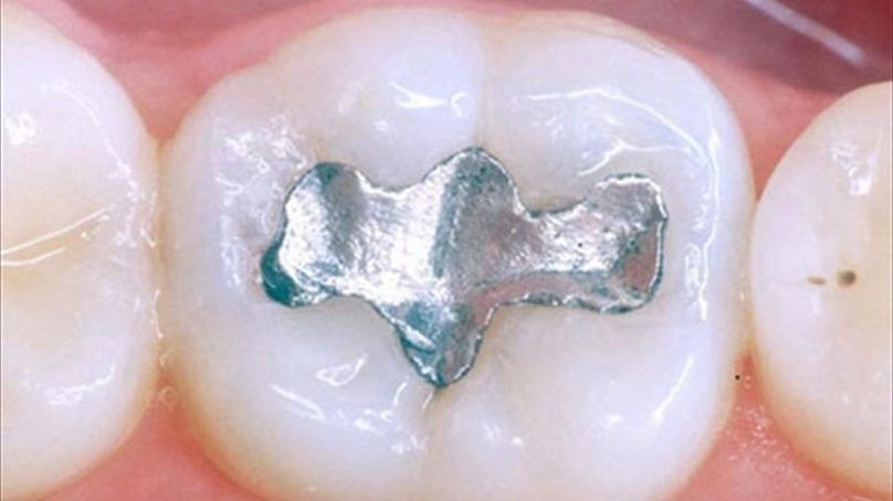 L’Ue vieta l’amalgama nei bambini, nelle donne in gravidanza o durante l’allattamento