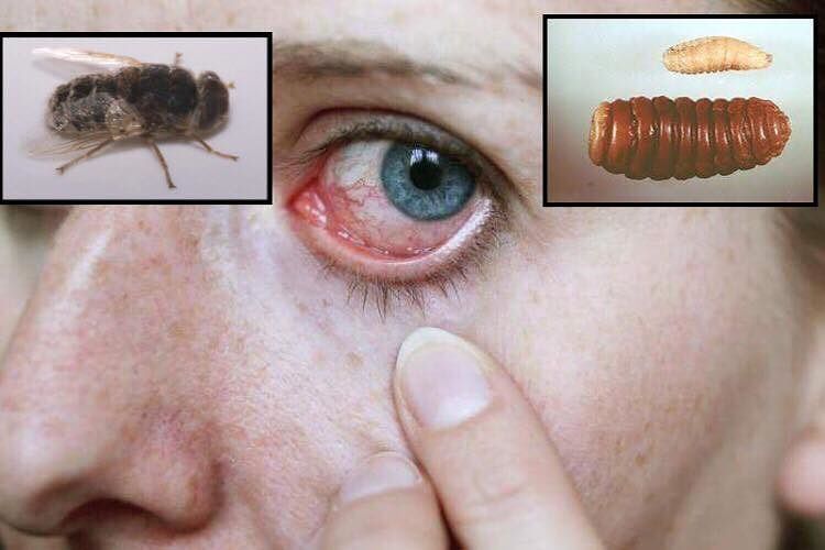 Mosca sparalarve colpisce una donna nell’occhio: ecco come attacca la “aestrus ovis”