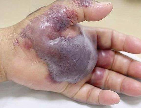 Diabetico mangia sushi al ristorante e si becca un’infezione: i medici gli amputano la mano