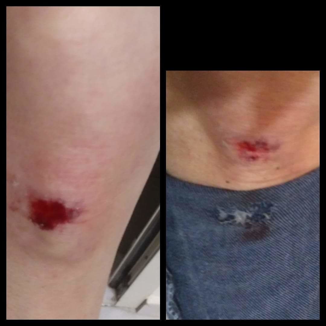 Quartu, cade in una buca davanti al Comune e si ferisce: “L’avevo segnalata un mese fa”