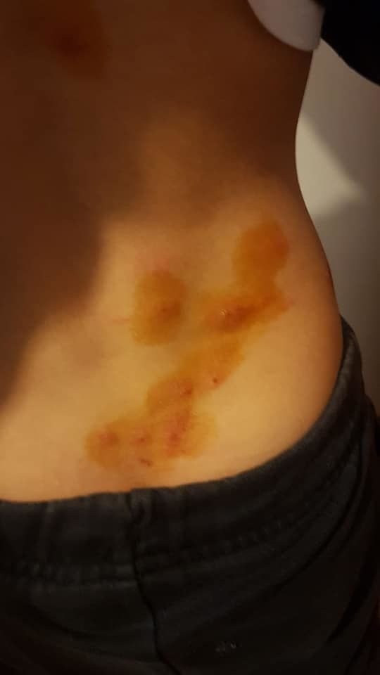 Allarme a Pirri: segnalate pericolose punture di insetti, il Comune chiude il parco dell’ex Vetreria