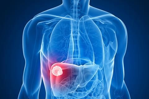 “Epatite C in Sardegna: il grande sommerso dei pazienti”