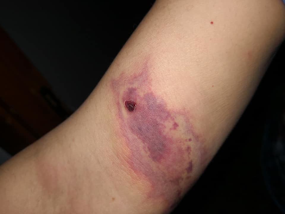 “Mia moglie, morsa da un ragno violino a Gergei: poi è finito nella ciotola dei cani…”