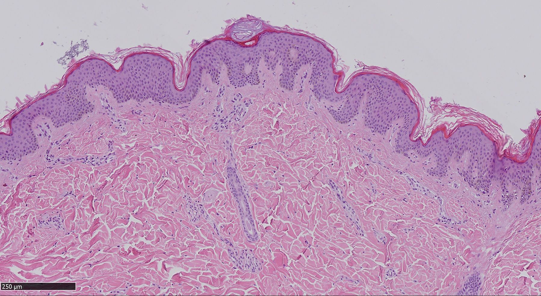 Melanoma maligno, una patologia in rapida crescita: in Sardegna 180 nuovi casi all’anno