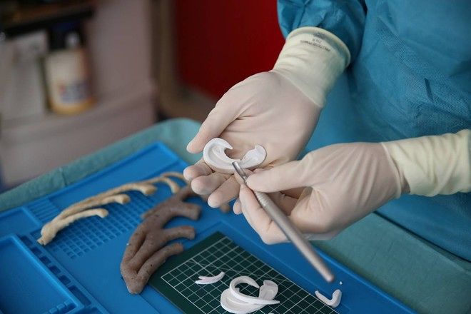 Bambino italiano nasce senza un orecchio: per la prima volta viene ricostruito dai medici in 3d