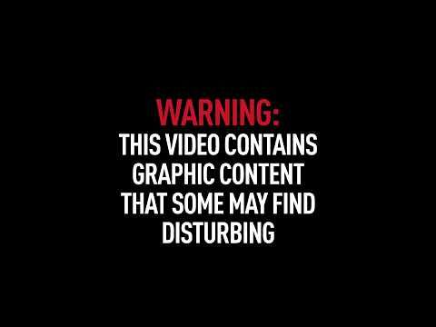 Fuma sigarette per 30 anni: i polmoni sono carbonizzati – IL VIDEO CHOC