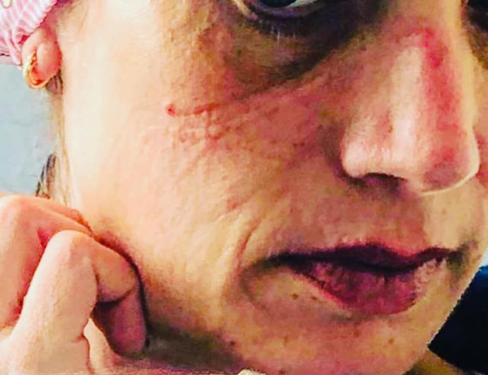 Cagliari, la scelta coraggiosa di Manuela e il volto segnato: “Infermiera nei reparti Covid del Santissima Trinità”