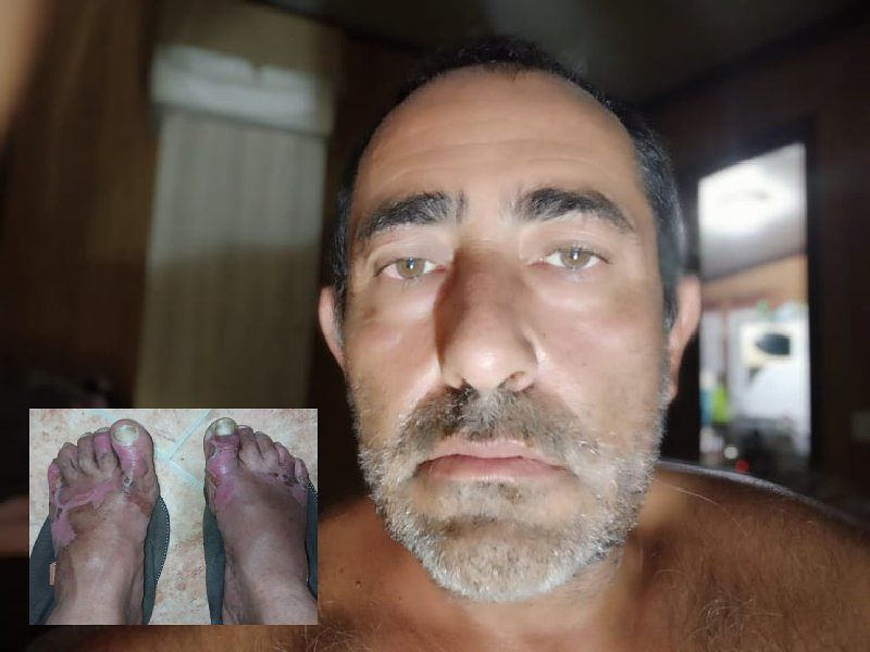 Cagliari, piedi bruciati dopo una passeggiata a Giorgino: “Non cammino da 15 giorni”