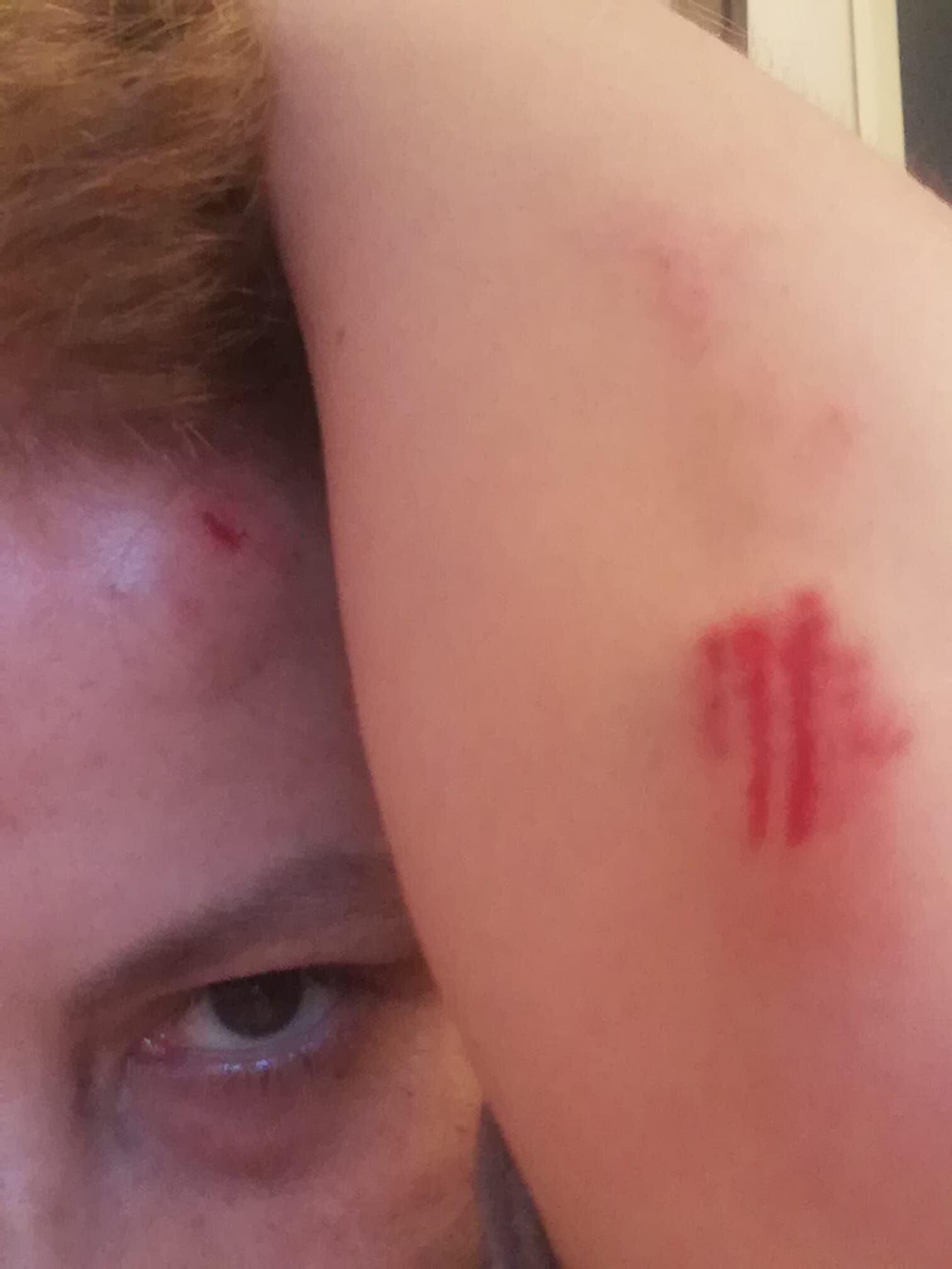 “Io, ferita dopo la caduta dalla bici: tenete sempre il guinzaglio ai cani, grazie a chi mi ha soccorsa”