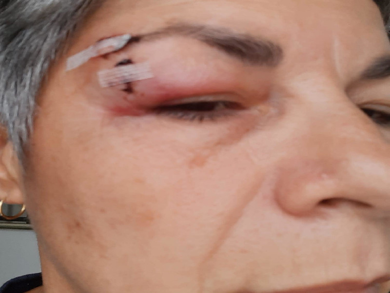 Quartu, inciampa in una buca e si ferisce in via Trento: “Punti vicino all’occhio, quando riparerete la strada?”