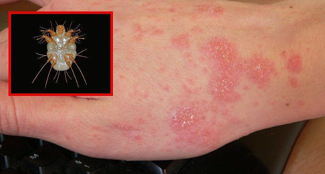 Tre scuole chiuse per scabbia in 2 giorni a Cagliari, “Dopo il lockdown contatti stretti in aumento”