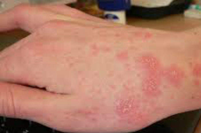 Cagliari, casi di scabbia in classe: chiusa la scuola primaria di via Castiglione