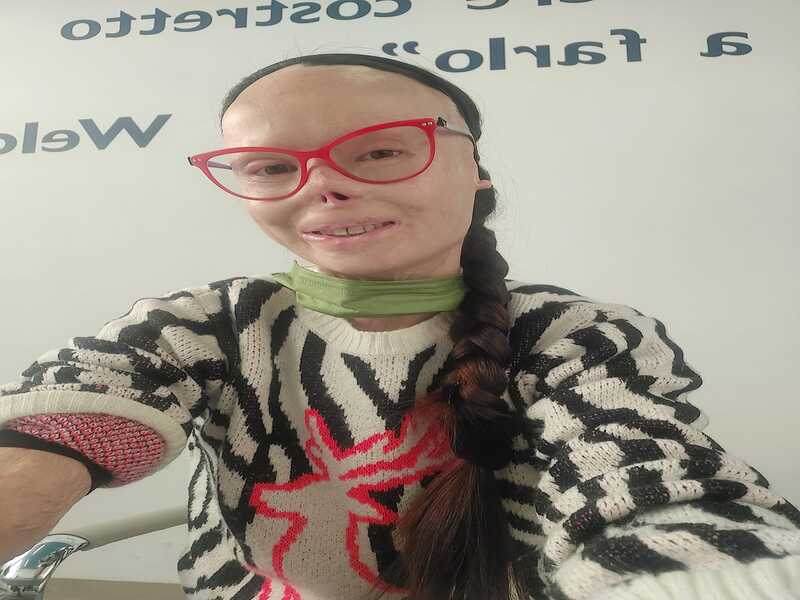 Una mano bionica a Valentina Pitzalis: “Mi sento Wonder Woman, oggi inizia la mia seconda vita”