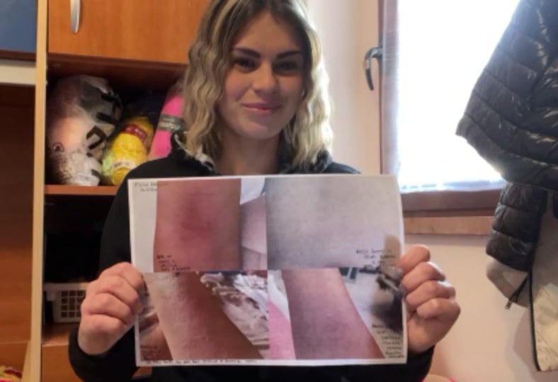 Jessica, 30enne sarda: “Orticaria e tachicardia dopo il vaccino, ho allergie ma non mi danno l’esenzione” (VIDEO)