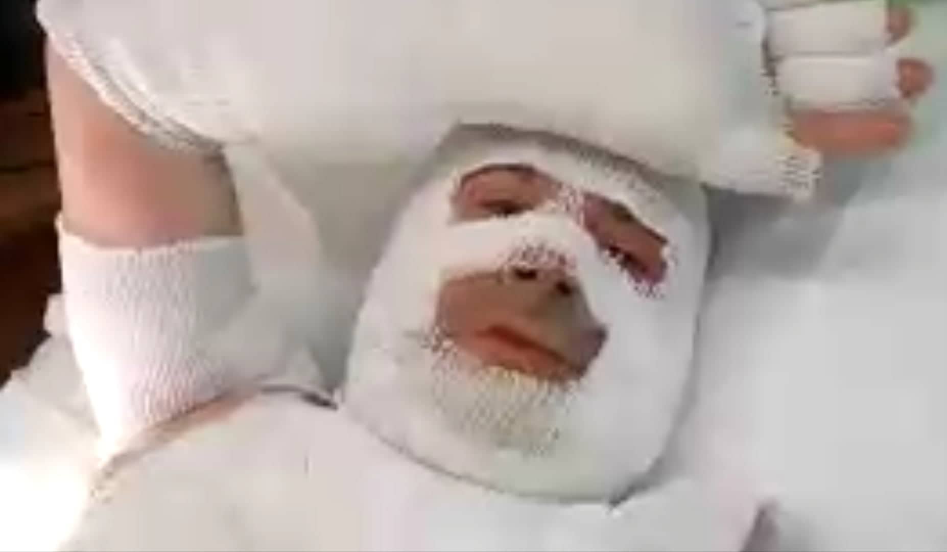 La grinta di Tonio Mura: “Ustionato nel mio ristorante a Cagliari, il fuoco mi ha avvolto la faccia: ora sto meglio” (VIDEO)