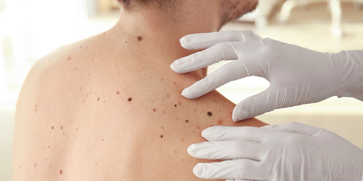 A Cagliari visite dermatologiche salate in privato: da 40 a 120 euro, anche 300 per togliere i nei
