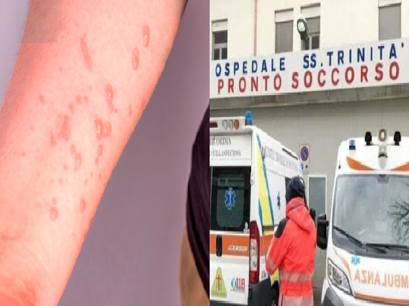 Cagliari, primo caso di vaiolo delle scimmie: la scoperta su un giovane positivo al Covid