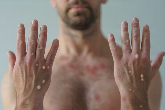 Cagliari, la scoperta del Policlinico: “Vaiolo delle scimmie su un 25enne ricoverato al Ss. Trinità”