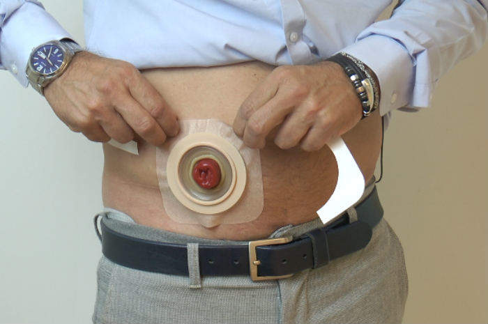 Sanità, allarme nel Sulcis: “Forniture delle sacche per gli stomizzati bloccate da 3 mesi”