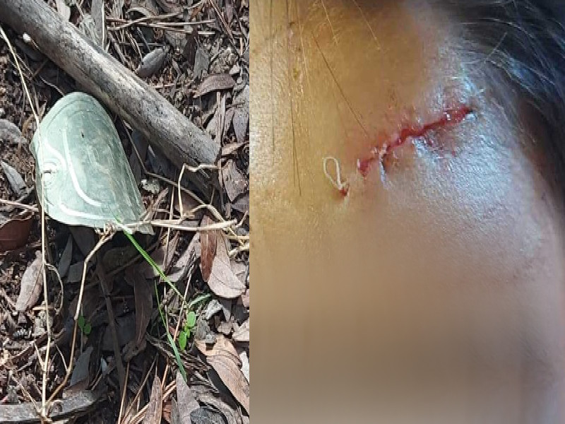 Cagliari, bimbo ko a Monte Urpinu: “Mio figlio caduto e ferito dal coperchio di una lattina, 21 punti”