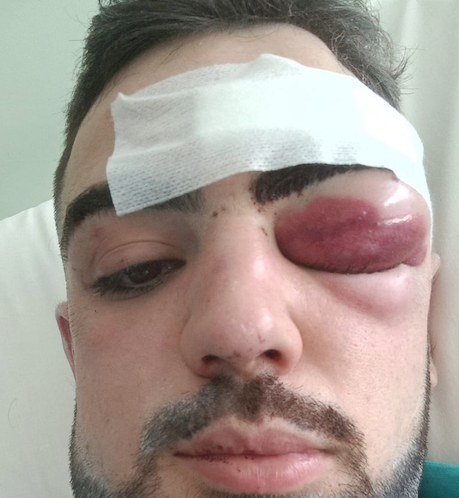 Ventiduenne pestato a martellate durante la festa di carnevale in Sardegna: denunciato l’aggressore