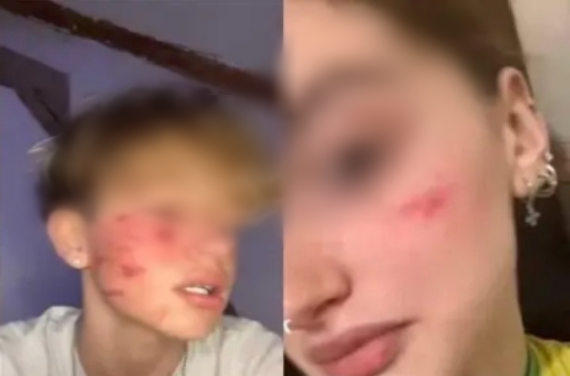 La sfida autolesionista dilaga anche tra i banchi di scuola sardi: ora la moda è strizzarsi la faccia