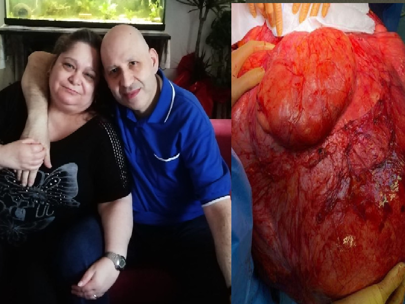 Tumore di 30 chili rimosso a Bologna, Giovanni Niolu di Guspini festeggia e attacca: “In Sardegna non ci sono le attrezzature”