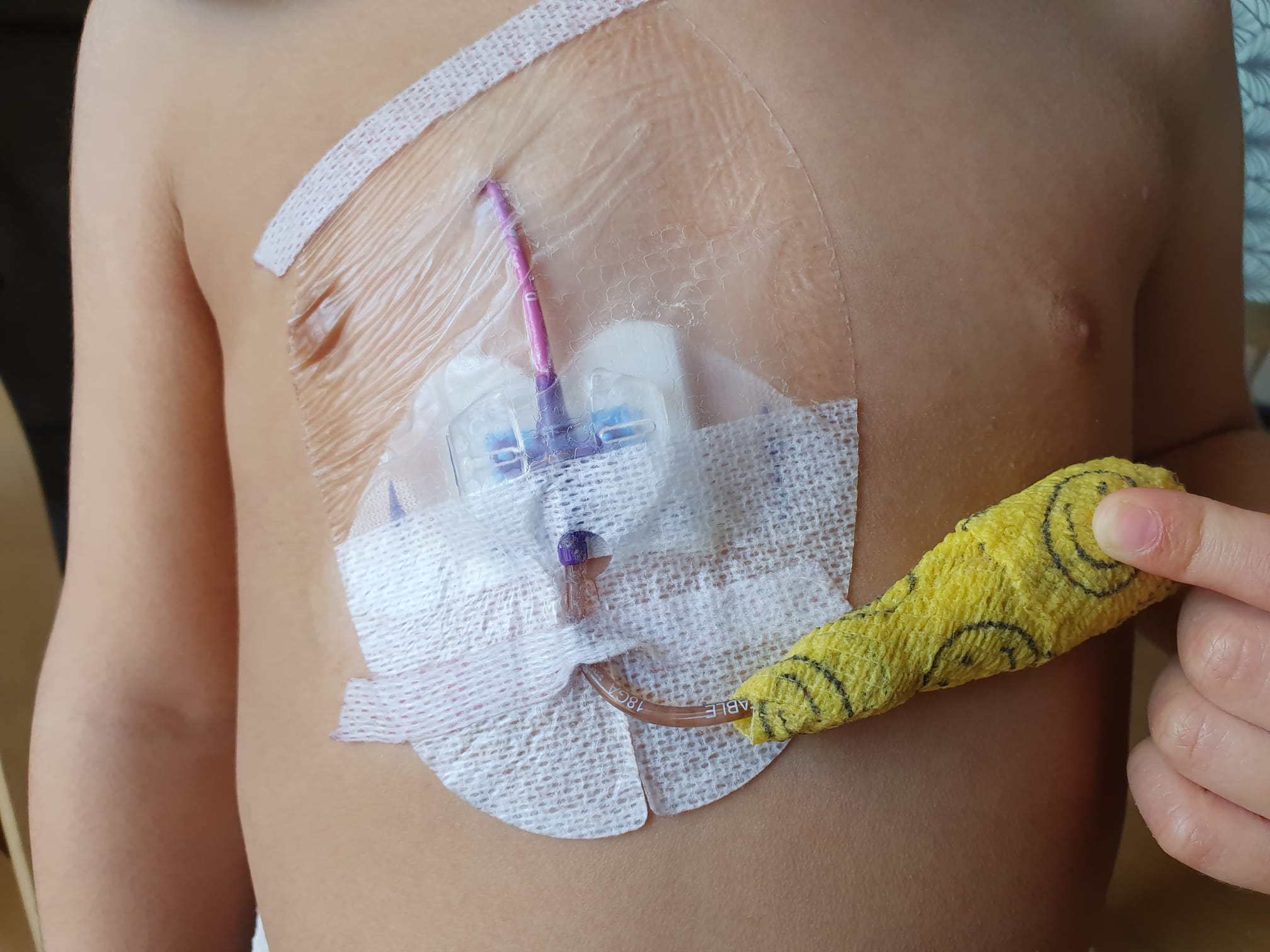 Pochi anestesisti al Microcitemico di Cagliari: “Bambini con i cateteri attaccati dopo tanti mesi”