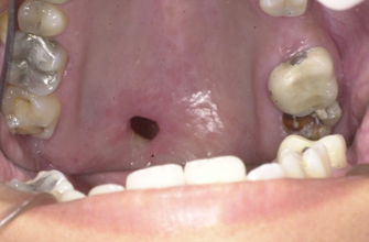 Cagliari, malasanità senza fine: “Un detenuto con un feroce mal di denti senza cure da 14 mesi”