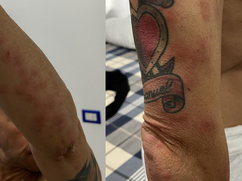 Cagliari, la denuncia di Emanuel: “Punto dalle cimici che infestavano la mia cabina sul traghetto per la Sardegna”