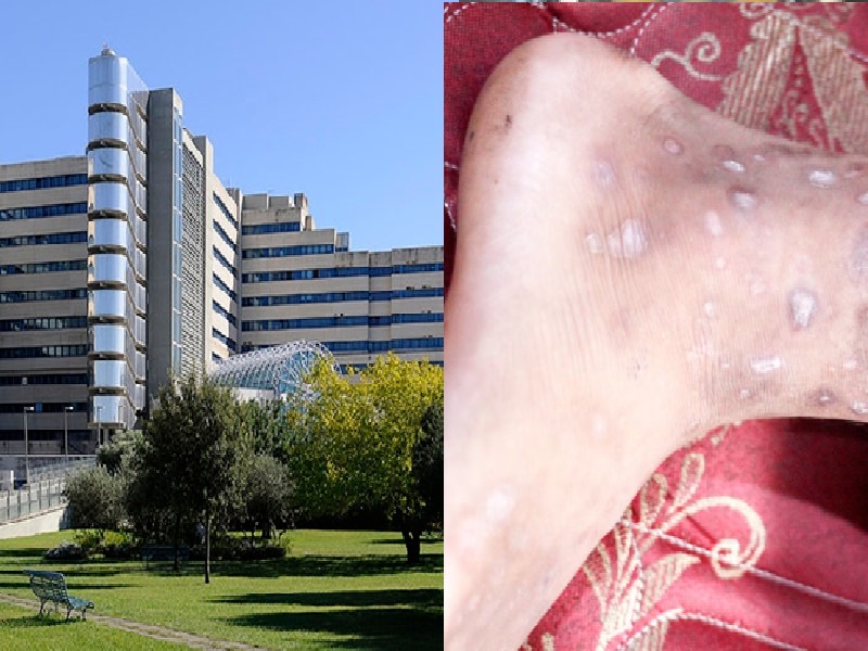 Cagliari, scabbia in reparto al Brotzu: contagiato un dipendente dell’ospedale