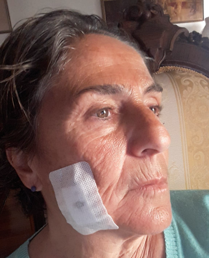 Cagliari, sfregiata da un ramo spezzato mentre prendeva il sole al parco