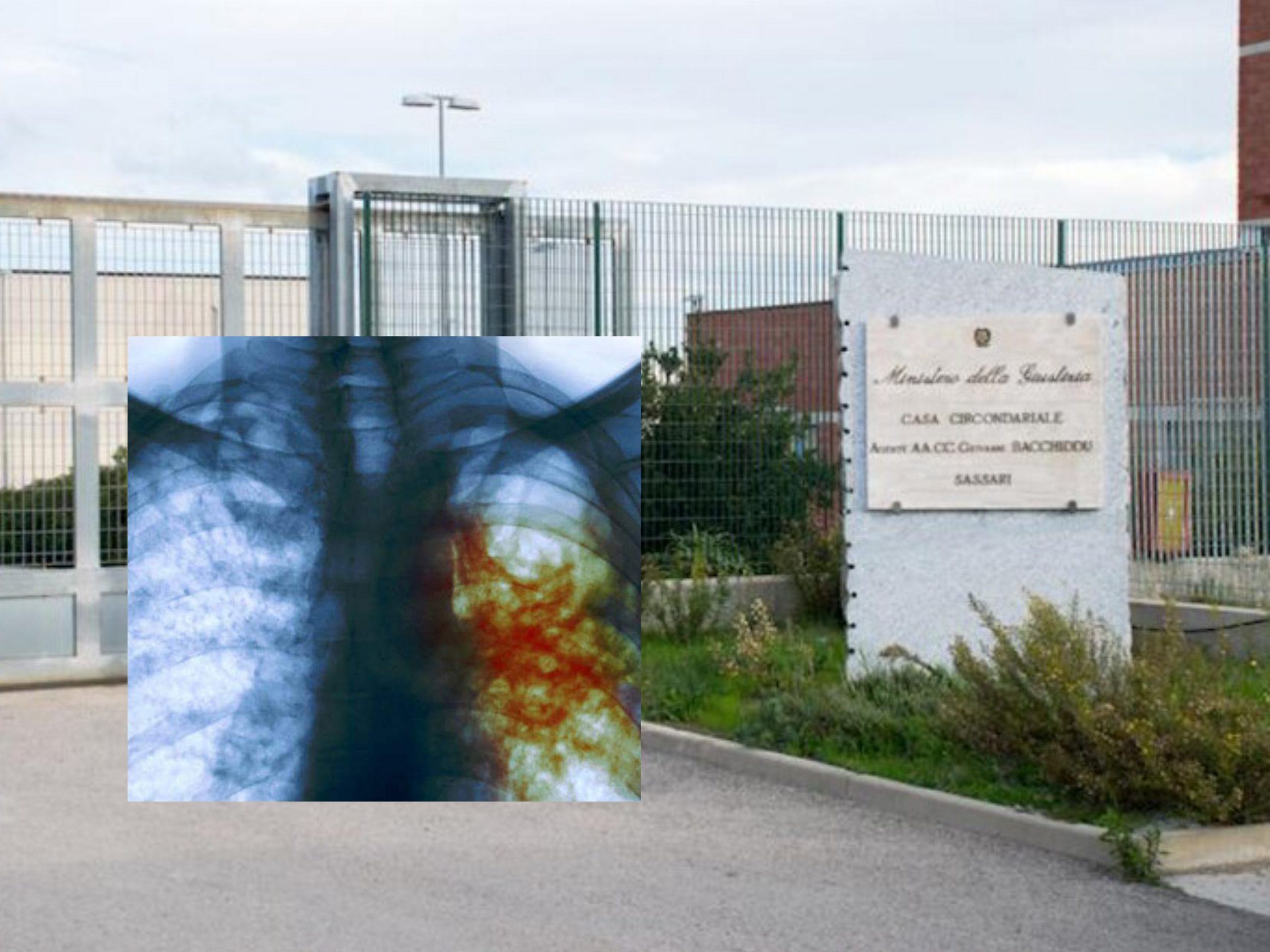 Emergenza turbercolosi nel carcere di Bancali: “Positivi un detenuto e un poliziotto, vogliamo i numeri reali”