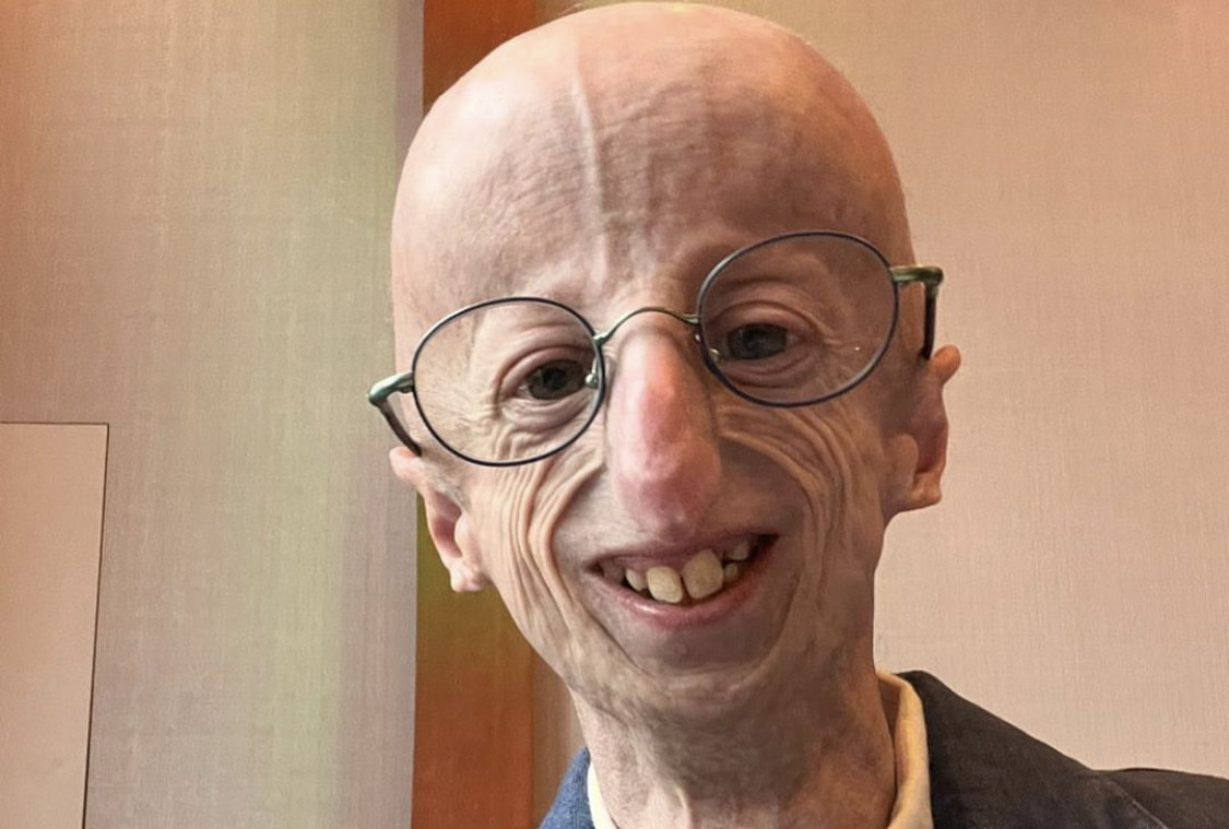 Addio a Sammy Basso, il ragazzo malato di progeria è morto a 28 anni
