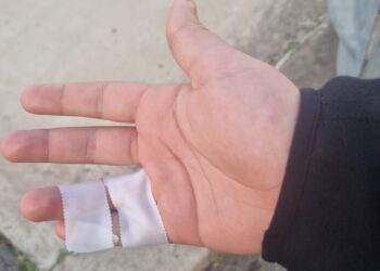 “Cagliari, il pronto soccorso nega la lastra a mio figlio: dimesso con fasciatura in “stile scout”