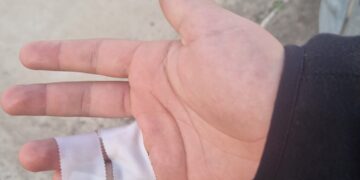 “Cagliari, il pronto soccorso nega la lastra a mio figlio: dimesso con fasciatura in “stile scout”