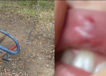 Siliqua, altalena pericolante si rompe e finisce in faccia a una mamma