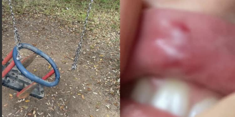 Siliqua, altalena pericolante si rompe e finisce in faccia a una mamma