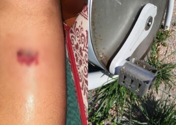 “Quel gioco è pericoloso”: profonda ferita fino all’osso per un ragazzino di 11 anni a Quartu