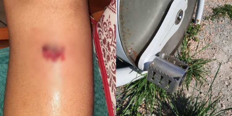 “Quel gioco è pericoloso”: profonda ferita fino all’osso per un ragazzino di 11 anni a Quartu