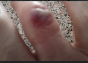 “Senza anestesia e con le pinze sbagliate, ridevano mentre io piangevo dal dolore”: il racconto di Claudia, paziente lasciata senza cure adeguate