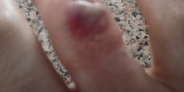 “Senza anestesia e con le pinze sbagliate, ridevano mentre io piangevo dal dolore”: il racconto di Claudia, paziente lasciata senza cure adeguate