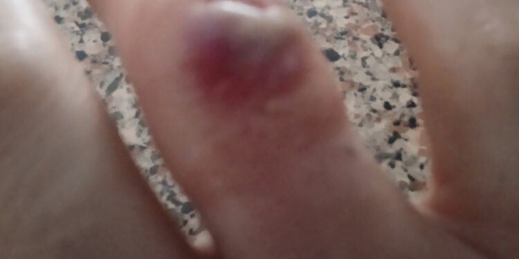 “Senza anestesia e con le pinze sbagliate, ridevano mentre io piangevo dal dolore”: il racconto di Claudia, paziente lasciata senza cure adeguate